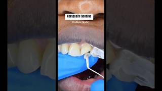 Composite Bonding on front tooth viral composite compositebondingcosmeticssmileteethdentist [upl. by Ayouqat]