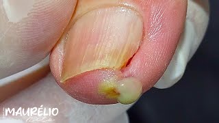 DEDO ENCRAVADO podologomaurelio podiatry satisfying [upl. by Eledoya692]