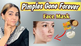 ACNE treatment At Home  3 Day Acne Removal Challenge  Clear Acne At Home  Beautify with Nadia [upl. by Anelegna]