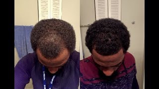 Rogaine Minoxidil Journey  Week 10 [upl. by Sigfried]