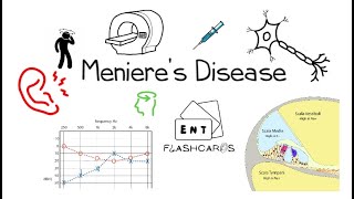 Ménières Disease  FRCS ENT Exam Essentials [upl. by Behlau636]