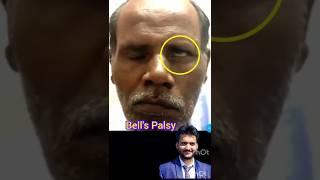 Bells palsy shorts [upl. by Ardnot]