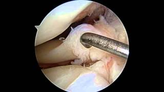 Lateral Meniscus Repair [upl. by Nosreh]