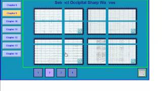 EEG in Epilepsy [upl. by Alpert]