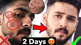 ব্রন ও ব্রনের দাগ দূর করার উপায়  100  কার্যকরী  Pimple  Darksopt Remove in Bangla [upl. by Enala]