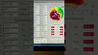 Epion Photorefractive CXL for advanced keratoconus 10yo boy Kanellopoulos MD [upl. by Annavas781]