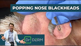 Popping Nose Blackheads  Dr Derm [upl. by Annahavas]