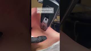 Chin and neck lift at SEV Laser with Moprheus8 [upl. by Ajar]