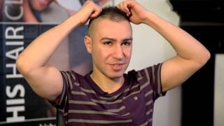 Scalp MicroPigmentation  AJ goes to HIS Hair Clinic after  DermMatch Concealer User [upl. by Nunes]