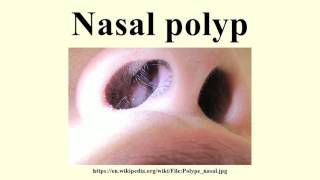 Nasal polyp [upl. by Barbur]