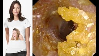 20 Years of Earwax Ear Wax Ear Wax Removal [upl. by Abbate]