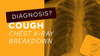 Chest XRay breakdown a guide to bronchiectasis on imaging [upl. by Klapp]