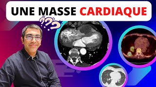 Une masse dans le VD  thrombus métastase ou tumeur primitive  Comment raisonner sur le SCANNER [upl. by Cogan]