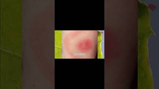 5 Black Legged Tick  Deer Tick tick deertick blackleggedtick lymedisease [upl. by Eerahc586]