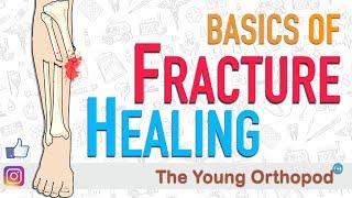 Fracture Healing  ANIMATION  BASICS  The Young Orthopod [upl. by Tterb]