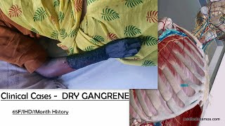 Dry Gangrene Case discussion in brief  Ischemic Heart Disease  3D Anatomy [upl. by Asin146]