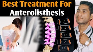 anterolisthesis l5 s1 treatment Spondylolisthesis grade 1 treatment exercises grade 2 l4 L5 Hindi [upl. by Etnoek]