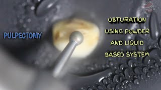 pulpectomy and obturation demonstration using powder and liquid based system [upl. by Salomo]