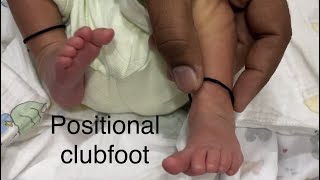 Ask your doctor 3 what is Positional clubfoot treatment childorthocare [upl. by Ahsert]