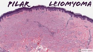 Leiomyoma Pilar Type Piloleiomyoma 5Minute Pathology Pearls [upl. by Siram41]