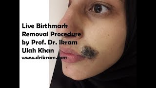 Laser Beauty in Action Watch Birthmark Removal Live lasertherapy live birthmarkremoval [upl. by Meneau140]