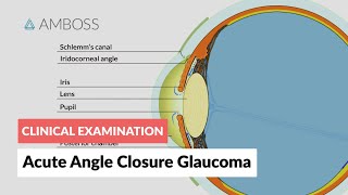 Acute Angle Closure Glaucoma [upl. by Reggis]