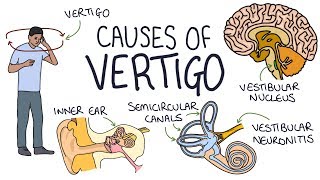 Understanding the Causes of Vertigo [upl. by Neelhtak]