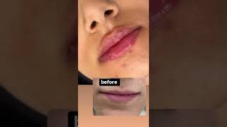 Natural Lip Enhancement with 1cc Filler  Subtle Lip Height and Center Lift [upl. by Aslehc]