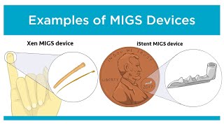 Innovations in Glaucoma Treatment MIGS [upl. by Newberry]