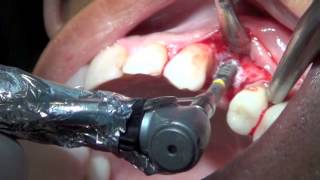 Indirect Sinus lift [upl. by Henarat]