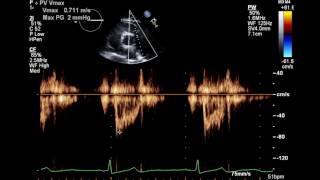 Normal Complete 2D Echocardiogram with Color Doppler and Spectral Doppler [upl. by Akins64]