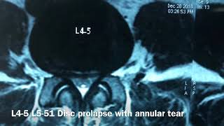 Lumbar Transforaminal epidural Injection [upl. by Sikata]