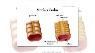 Die Symptome von Morbus Crohn [upl. by Kho]