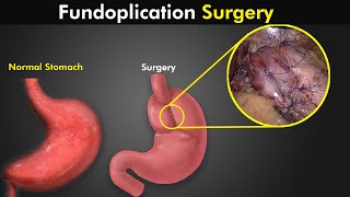 How Fundoplication Procedure Is Performed To Treat GERD or Acid reflux [upl. by Vardon216]