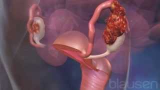 Ovarian cancer Medical animation [upl. by Llevram]