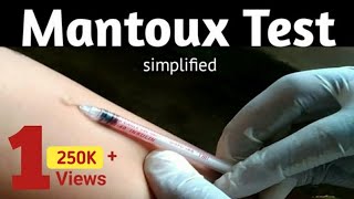 Mantoux Test to diagnosis TB infection  MT or TST or PPD Principle and Procedure [upl. by Hirza444]