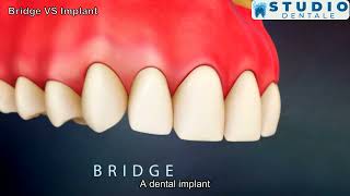 Bridge vs Implant Exploring Tooth Replacement Options We Care Health Center  Studio Dentale [upl. by Atte]