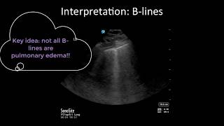 Pitfalls of Lung Ultrasound [upl. by Wootan]