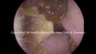 242  Soft Ear Wax Removal using Jobson Horne  Mr Neel Raithatha The Hear Clinic [upl. by Galina]