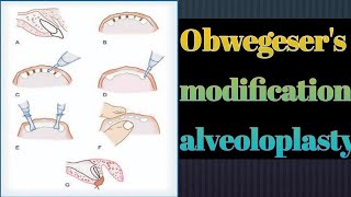 obwegesers modification  Deans alveoloplasty modification preprosthetic surgery alveoloplasty [upl. by Aenneea]