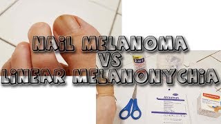 Nail Melanoma VS Melanonychia  learn from my story [upl. by Quartis]