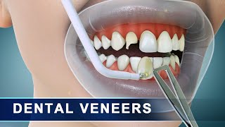 Veneers  Step by step preparation and placement of dental veneers  3d Animation [upl. by Polak]