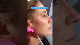 Armonizacion Facial con Acido Hialuronico [upl. by Rma]