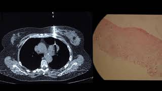 Pulmonary hamartoma a benign chest mass [upl. by Vanna699]