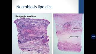 Basic Dermatopathology 11 Granulomatous [upl. by Atauqal]