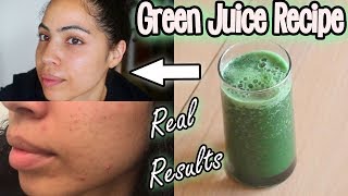 Celery Juice For Hormonal Acne One Month Results [upl. by Aitan]