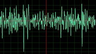 Coarcitation of the Aorta normal speed [upl. by Nivlag]