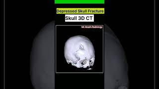 🩻Depressed Skull Fracture Skull 3D CT fracture skull shorts viral 3d ctscan medical [upl. by Gamages540]