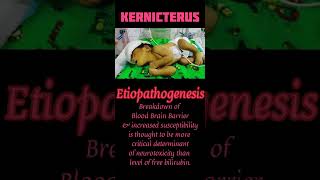 KERNICTERUS OF NEWBORN NEONATAL JAUNDICE BILIRUBIN ENCEPHALOPATHY [upl. by Phox]