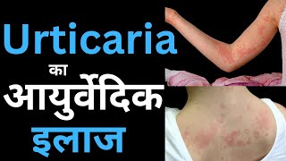 What is Urticaria Causes Home Remedies amp Ayurvedic Treatment [upl. by Iknarf]